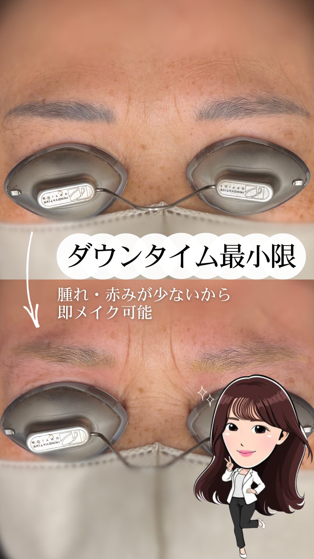 アートメイク除去イメージ