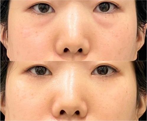 目の下のクマ取りの症例写真｜上：施術前、下：施術後の目元