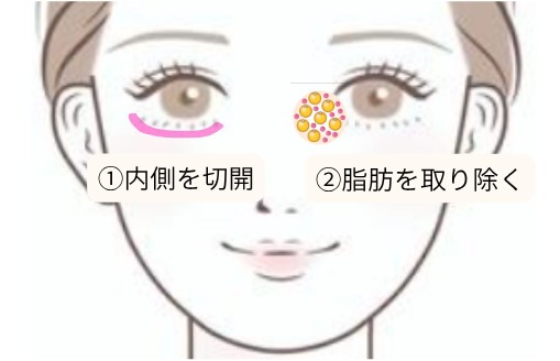 目の下のクマ取りの手術方法の図解｜①下瞼の内側を切開 ②眼窩脂肪を取り除く