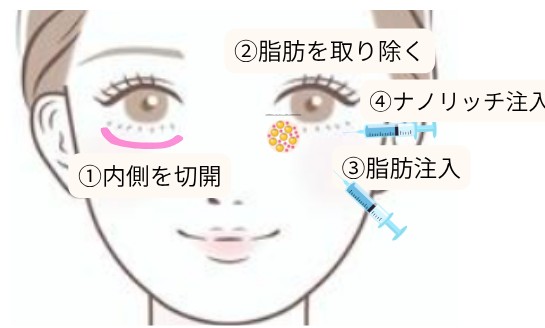 クマ取り＆脂肪注入の手術方法の図解｜①下瞼の内側を切開 ②脂肪を取り除く ③脂肪注入 ④ナノリッチ注入