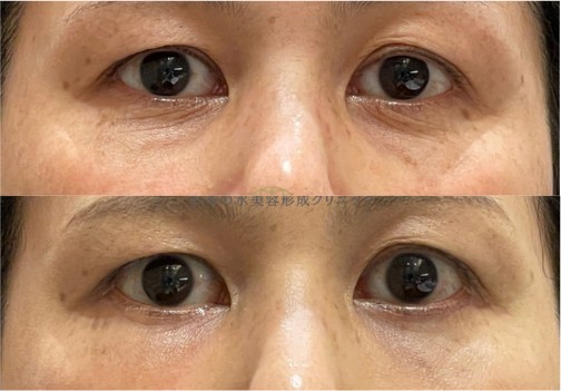 下まぶたのしわ取りの症例写真｜上：施術前、下：施術後の目元