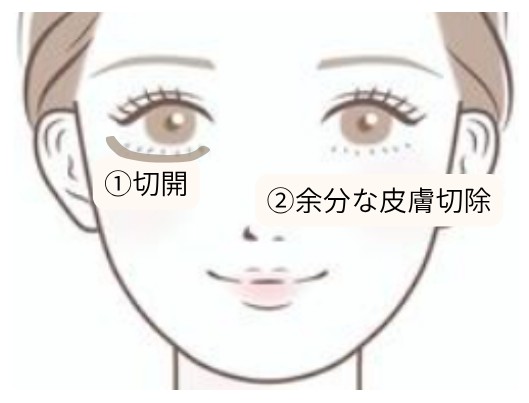 下まぶたのしわ取りの手術方法の図解｜①下まつ毛の下を切開 ②余分な皮膚を切除