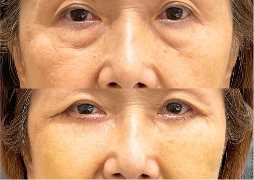 表ハムラの症例写真｜上：施術前、下：施術後の目元