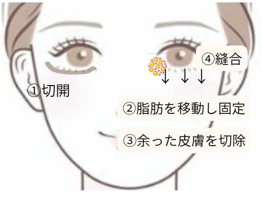 表ハムラの手術方法の図解｜①下まつ毛の下を切開 ②脂肪を移動し固定 ③余った皮膚を切除 ④縫合