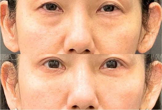 裏ハムラの症例写真｜上：施術前、下：施術後の目元