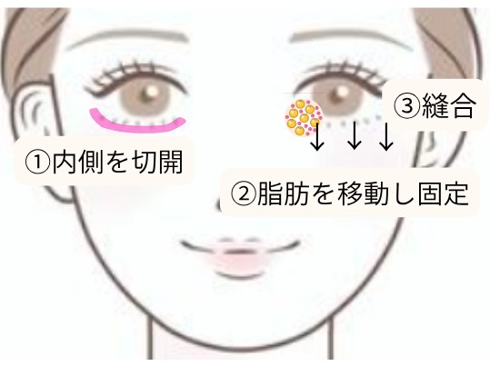 裏ハムラの手術方法の図解｜①下瞼の内側を切開 ②脂肪を移動し固定 ③縫合